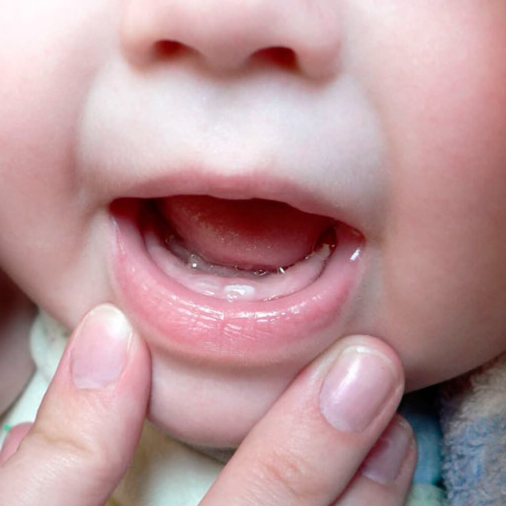 Во рту малыша температура. Прорезывание зубов у детей. Десна при прорезывании зубов.